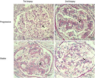 Factors associated with the progression of mesangial lesions in IgA nephropathy: A comparative analysis of renal re-biopsies